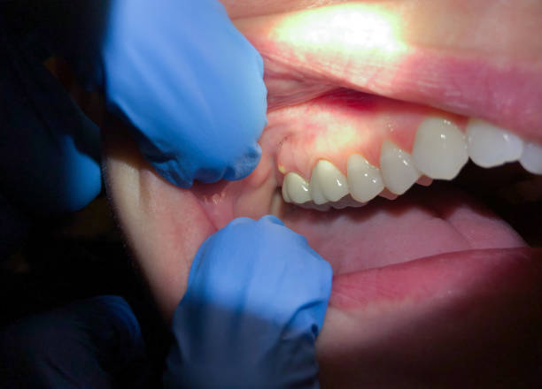 Best Emergency Wisdom Teeth Removal in Sebastian, TX
